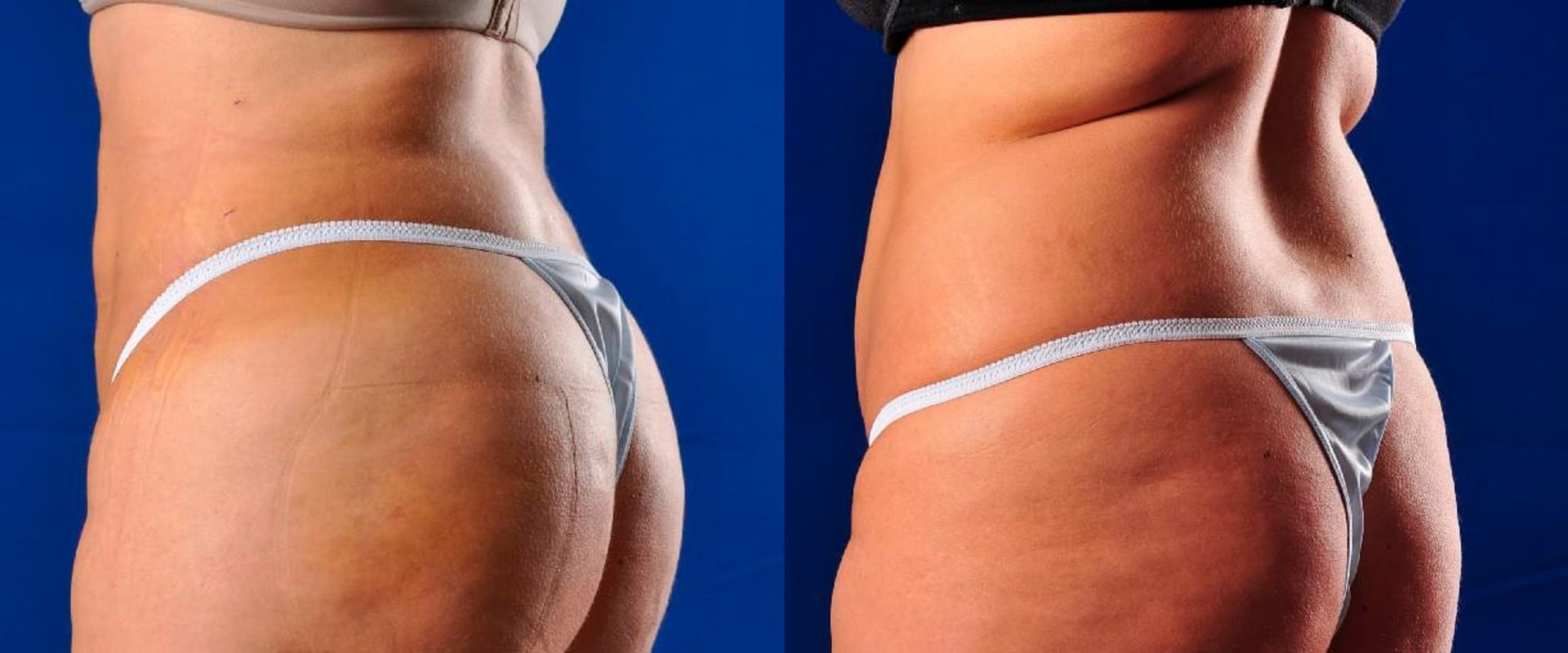 Bbl Surgeons Near Me Guide to Finding Qualifications and Success Rates