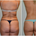 All You Need to Know About Finding Reliable Before and After Photos for a Bbl Surgery